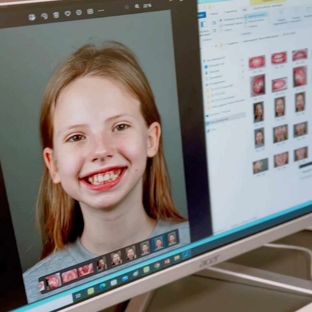 كم مدة تقويم الأسنان الأمامية