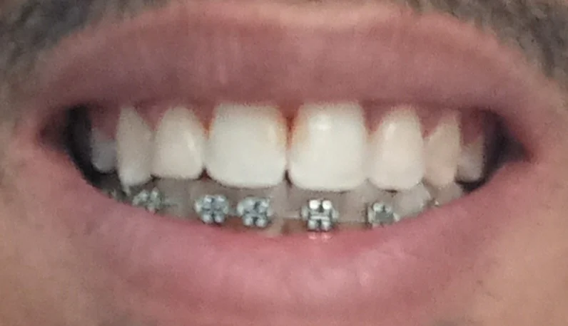 ثمن تقويم الأسنان في تونس